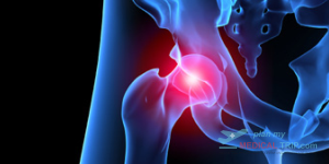 Total Hip Replacement for Cementless joint